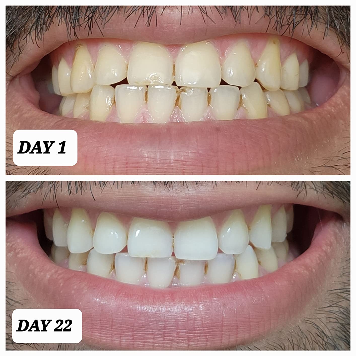 Crest 3D Whitestrips Professional Effects - Teeth Whitening Kit, 22 Treatments (20 + 2 Bonus), Each with 1 Upper/1Lower, 44 Strips - Crest 3DWhite Teeth Whitening Strips customer photo 2