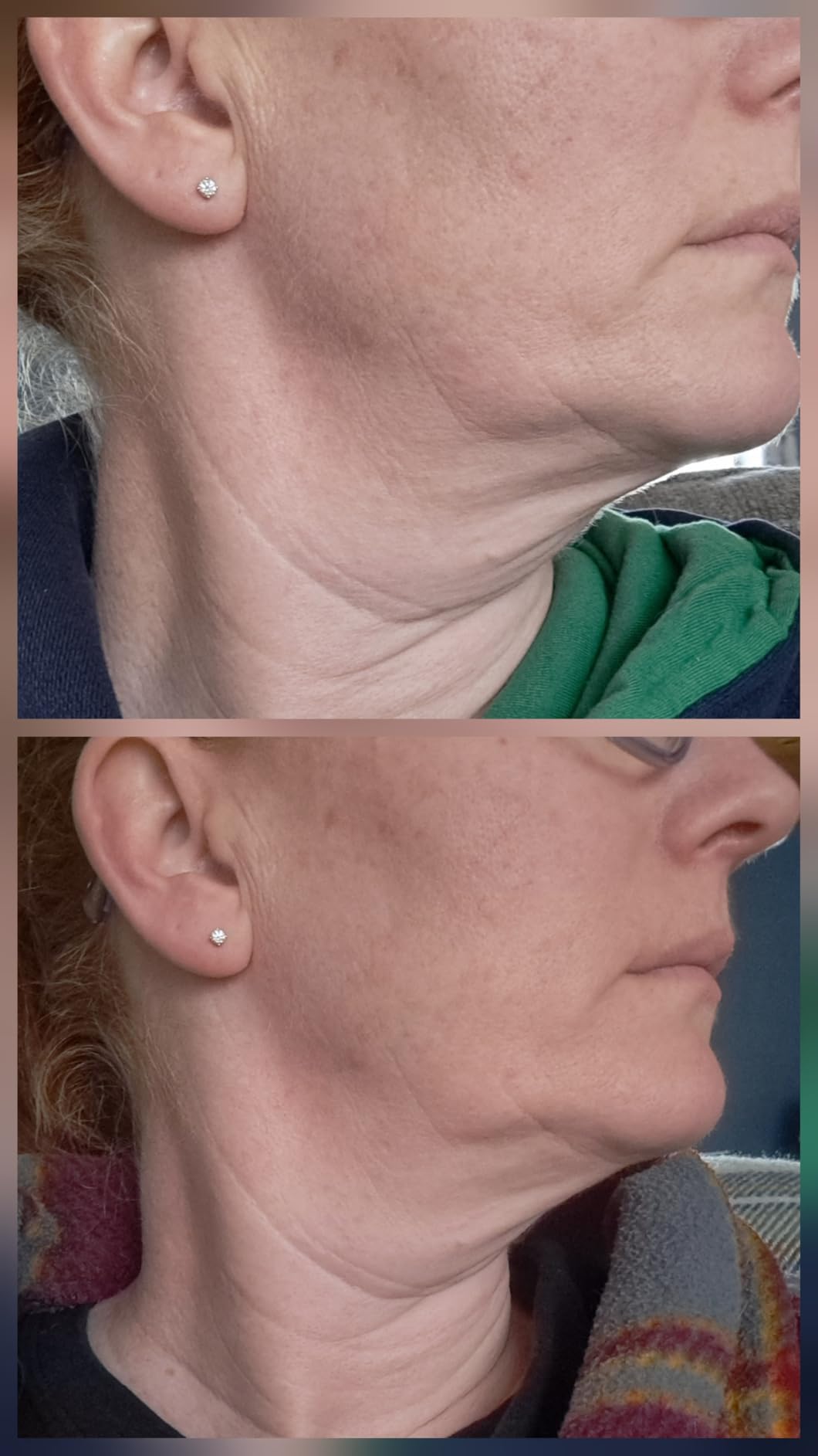 Gold Bond Age Renew Neck & Chest Firming Age Renew Cream, 2 oz., Clinically Tested Skin Firming Cream customer photo 2