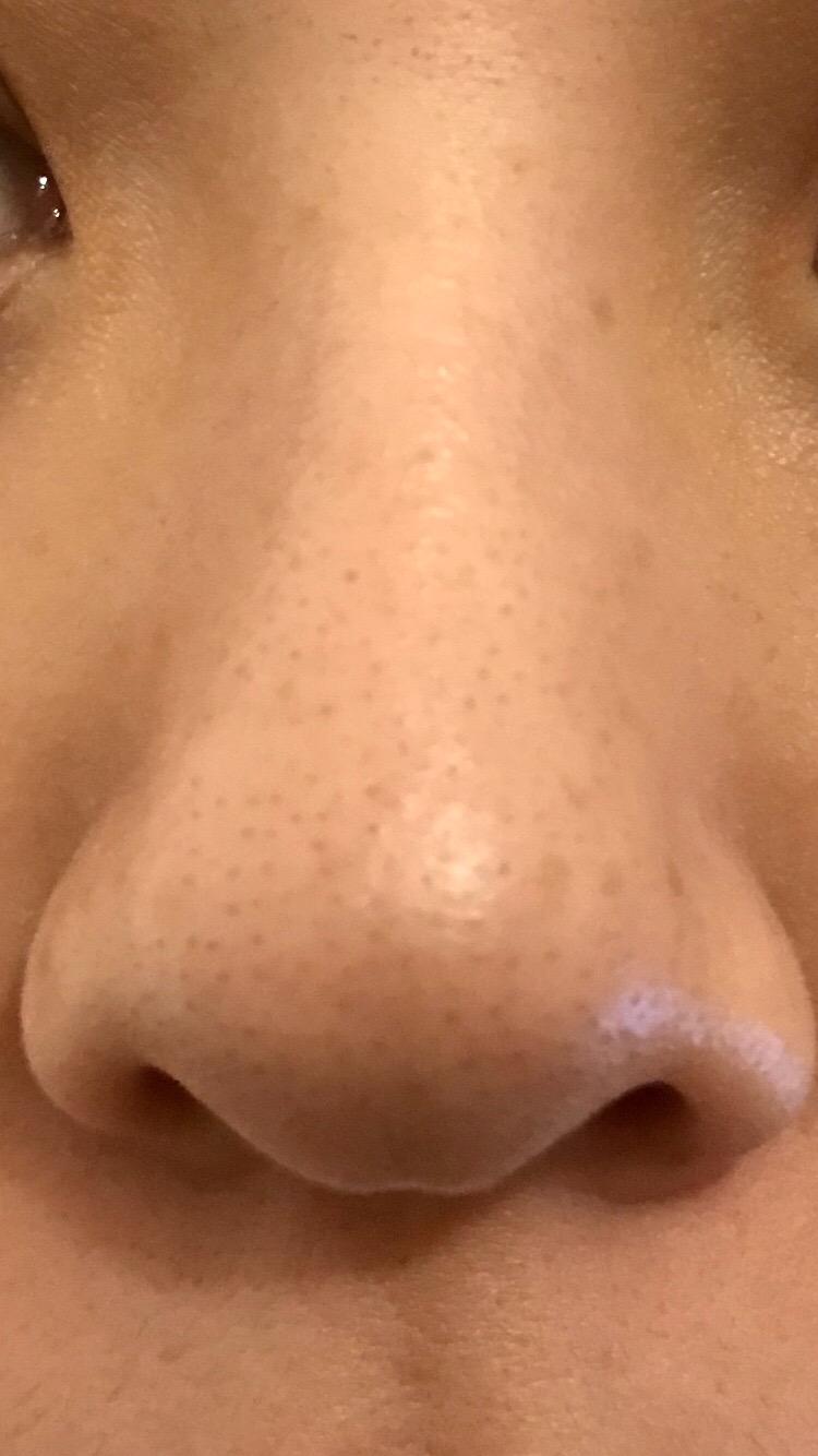 VOYOR Blackhead Remover Pore Vacuum - Electric Face Vacuum Pore Cleaner Acne White Heads Removal with 6 Suction Heads (BR410) customer photo 2