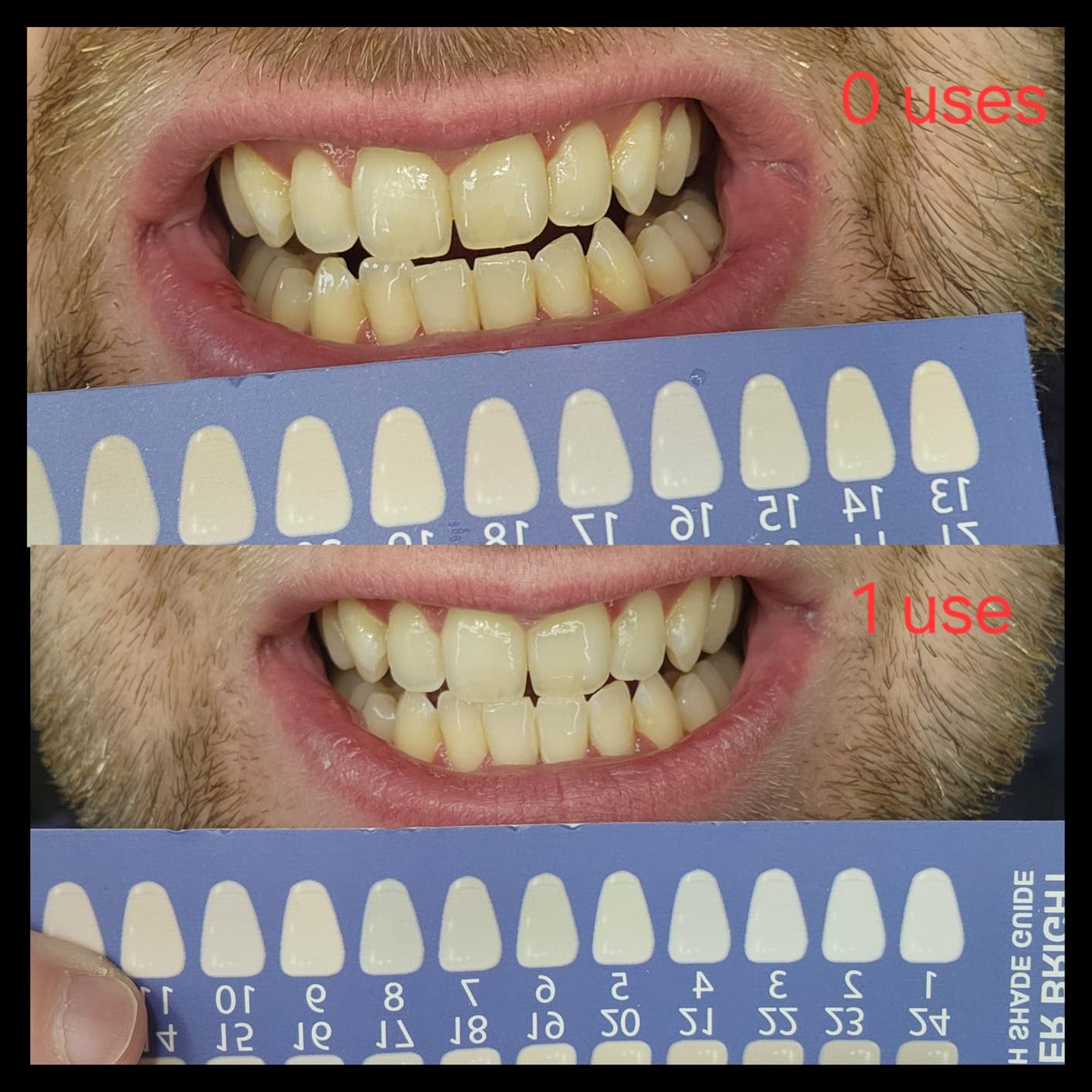 iSmile Teeth Whitening Kit - LED Light, 35% Carbamide Peroxide, (3) 3ml Gel Syringes, (1) Remineralization Gel, and Tray. customer photo 1