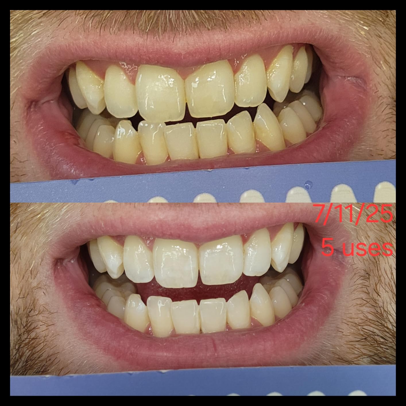 iSmile Teeth Whitening Kit - LED Light, 35% Carbamide Peroxide, (3) 3ml Gel Syringes, (1) Remineralization Gel, and Tray. customer photo 2