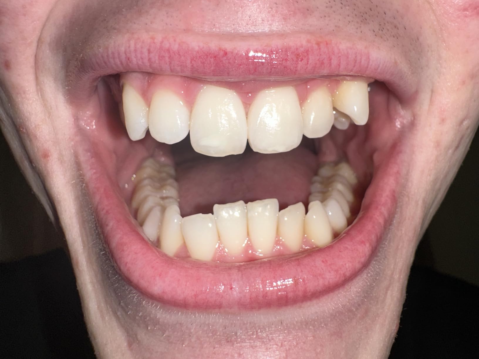 GuruNanda Teeth Whitening Strips - 7-Day Treatment with Non-Slip, Dry Strip Technology - Whitening Designed with Care for a Brighter Smile customer photo 1