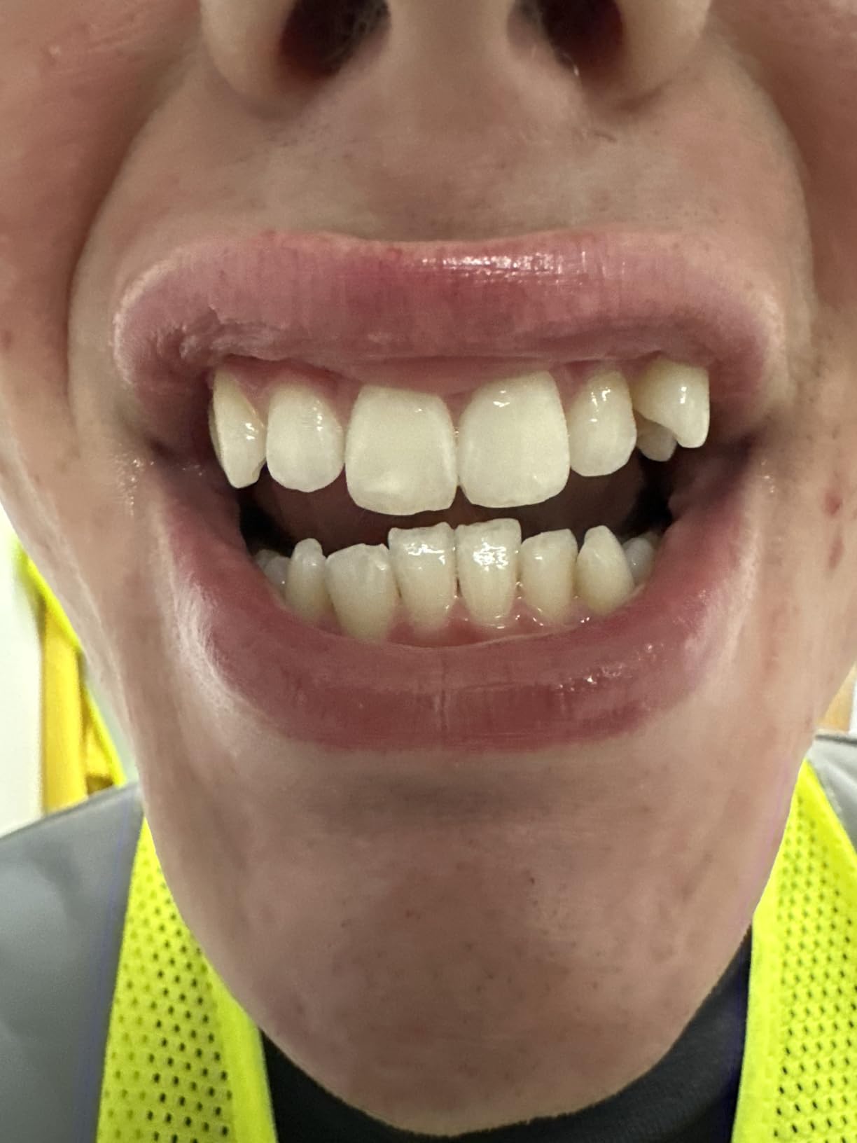 GuruNanda Teeth Whitening Strips - 7-Day Treatment with Non-Slip, Dry Strip Technology - Whitening Designed with Care for a Brighter Smile customer photo 2