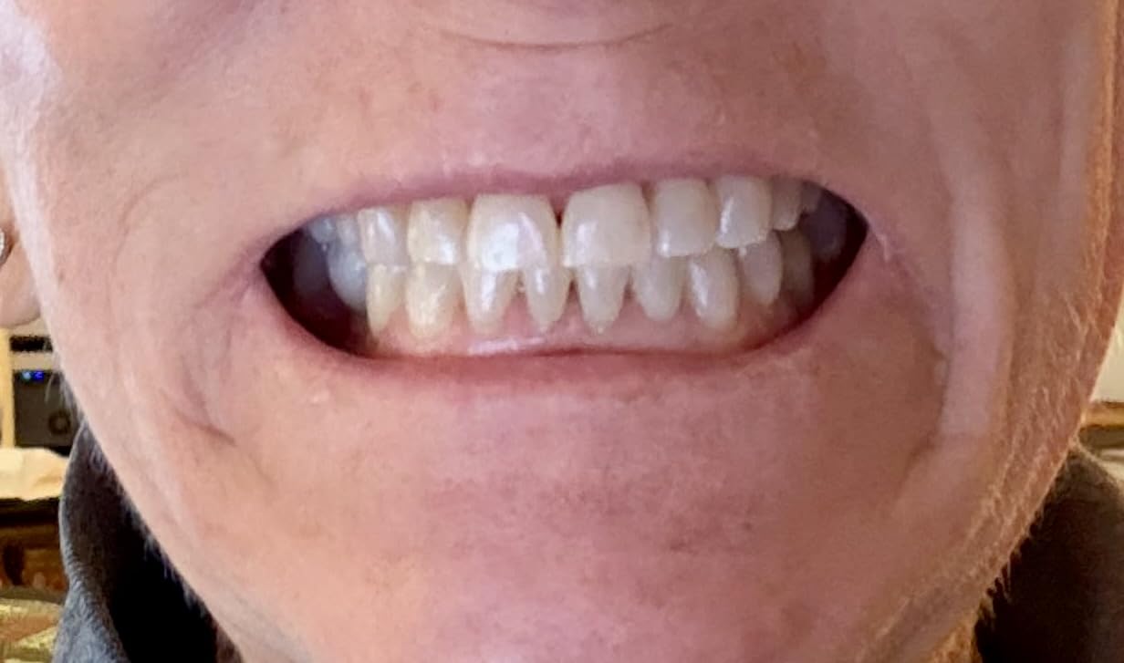 Crest 3D Whitestrips Sensitive White - Teeth Whitening Kit, 18 Treatments, Each with 1 Upper/1Lower, 36 Strips - Crest 3DWhite Teeth Whitening Strips customer photo 2