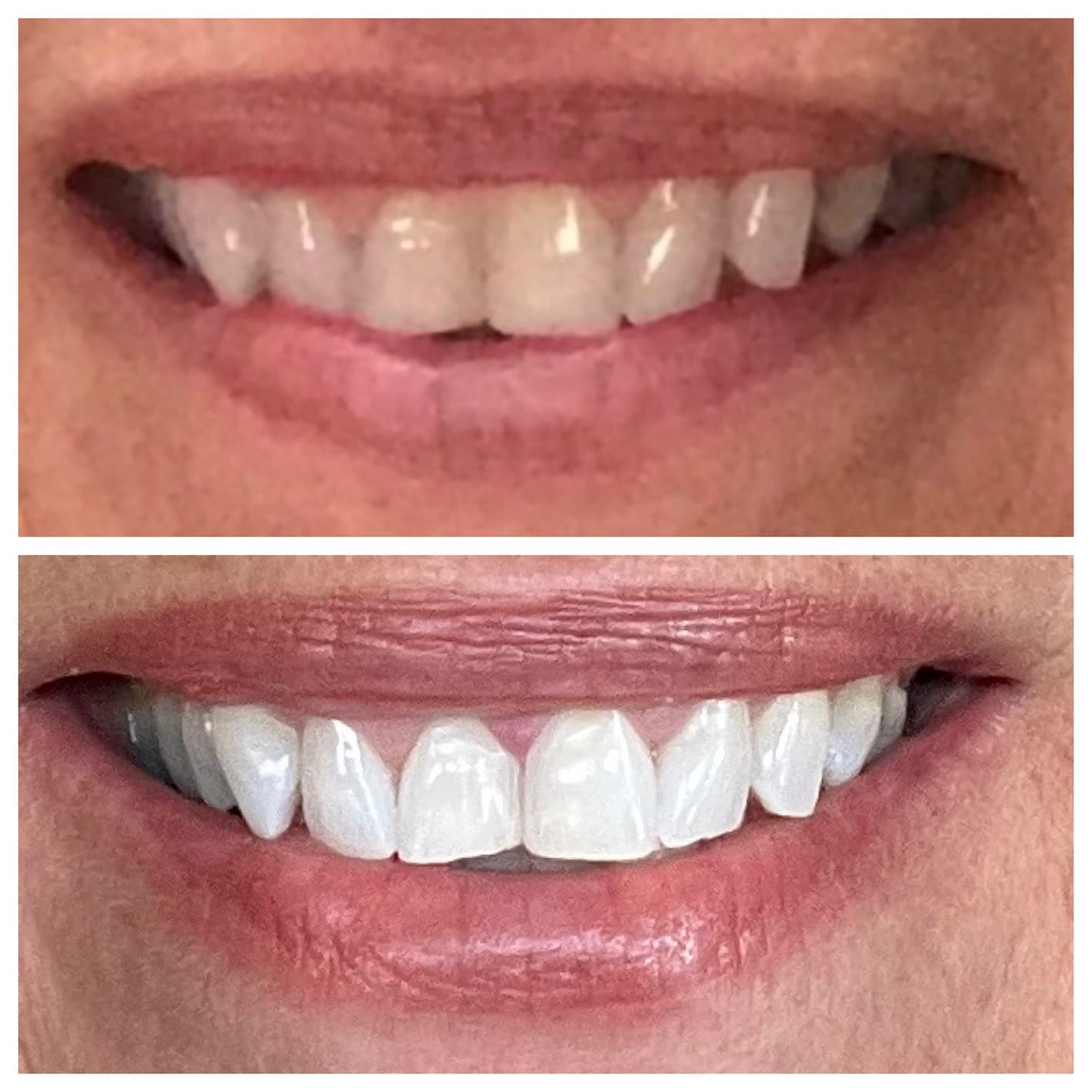 Teeth Whitening Pen Gel Kit: 35% Carbamide Peroxide Gel for Stain Removal - No Sensitivity with Remineralizing Pen for a Brighter Whiter Smile Mint (5 Pack) customer photo 2