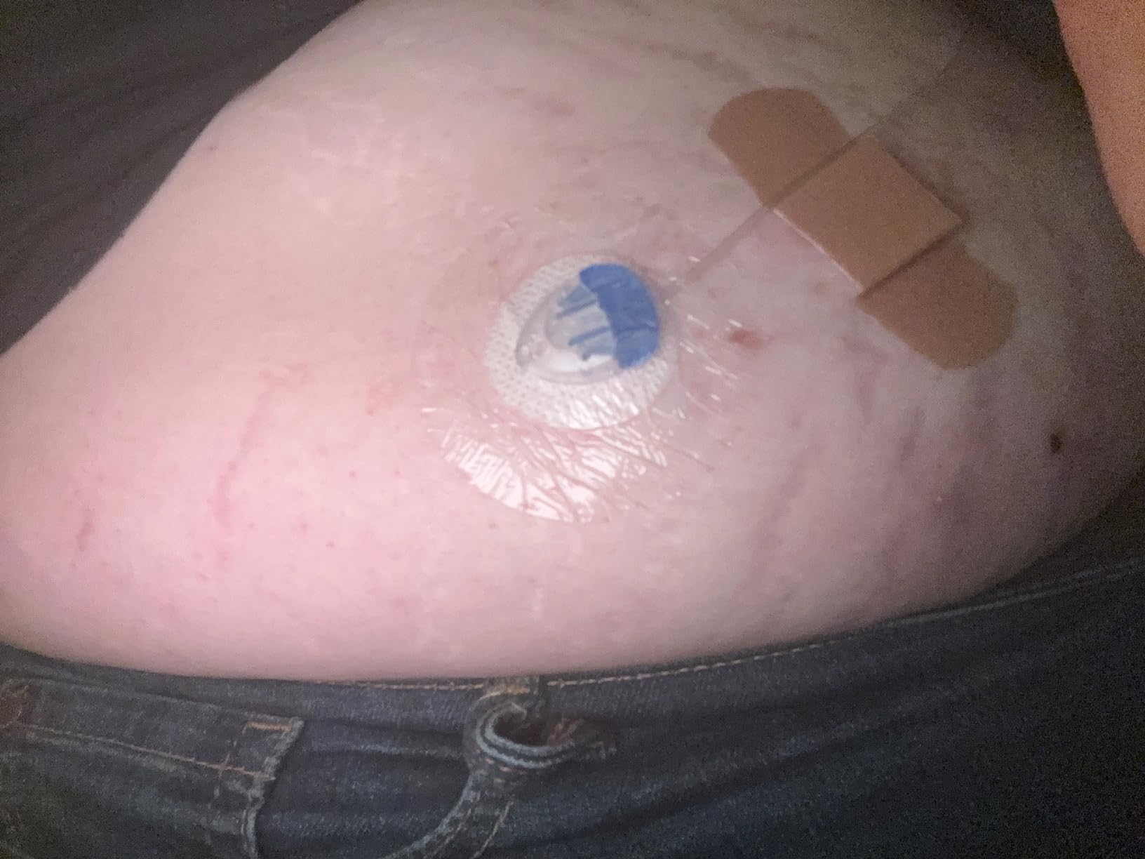 Universal Adhesive Patches for CGM and Insulin Pumps, 40 Pack Waterproof 10-14Days & Breathable Clear Patches customer photo 1