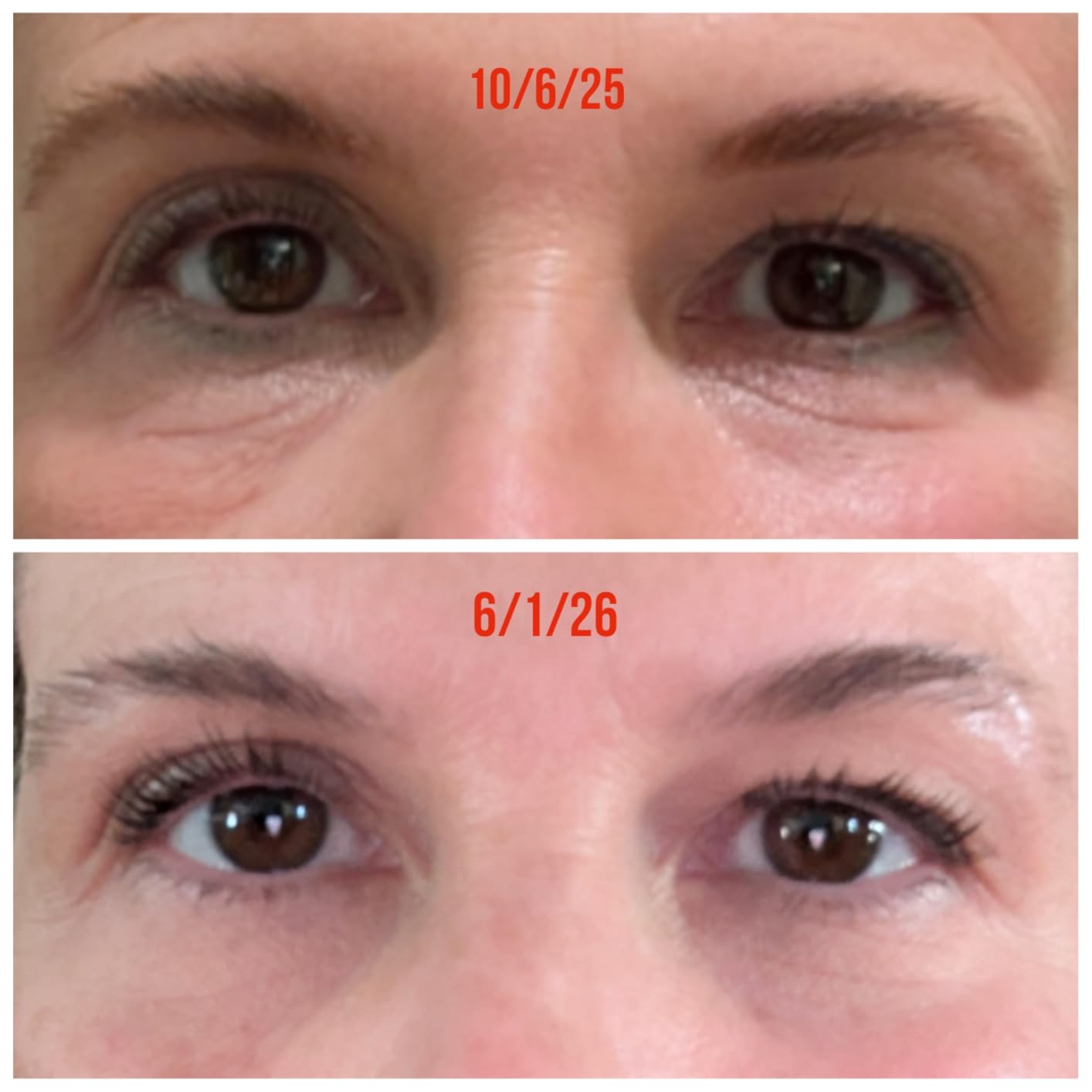 CeraVe Skin Renewing Eye Cream For Wrinkles, Under Eye Cream With Peptides + Caffeine + Niacinamide, For Wrinkles & Crows Feet, Paraben Free & Opthalmologist Tested customer photo 1
