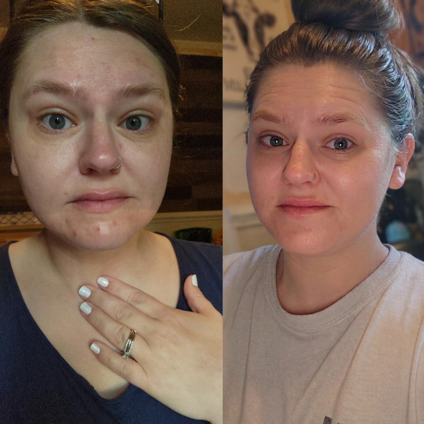The Ordinary The Acne Set, 3-Step Skin Regimen with Glucoside Foaming Cleanser, Salicylic Acid 2% Solution, and Natural Moisturizing Factors + Beta Glucan | Skin Care Set customer photo 1